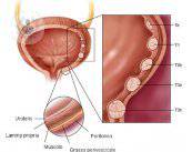 il-tumore-alla-vescica-la-terapia-con-synergo immagine dell'articolo