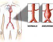 l-aneurisma-prevenzione-e-cura immagine dell'articolo