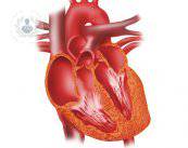 Consigli per prevenire l'infarto del miocardio