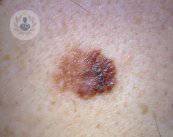 Il melanoma: come riconoscerlo e come sconfiggerlo