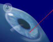 la-cataratta-l-intervento-con-il-laser immagine dell'articolo