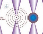 laser-l-evoluzione-dell-oftalmologia immagine dell'articolo