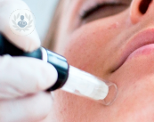 micro-needling-una-penna-per-una-pelle-piu-giovane immagine dell'articolo