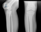 trattamento-dell-osteoma-osteoide-con-termoablazione immagine dell'articolo