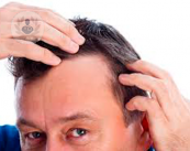 cura-dei-capelli-calvizie-e-trapianto immagine dell'articolo