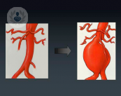 aneurisma-dell-aorta-addominale-un-killer-silenzioso immagine dell'articolo