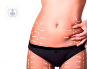 rimodellare-il-corpo-con-la-liposuzione immagine dell'articolo