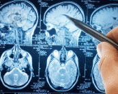 Tumore al cervello: le ultime novità in campo chirurgico
