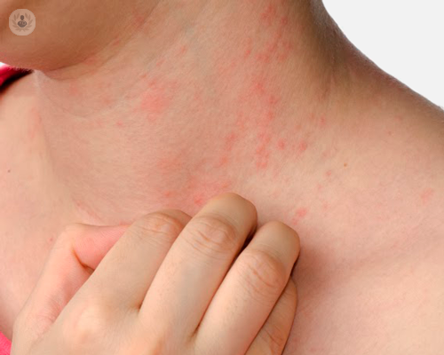 cosa-scatena-la-psoriasi immagine dell'articolo