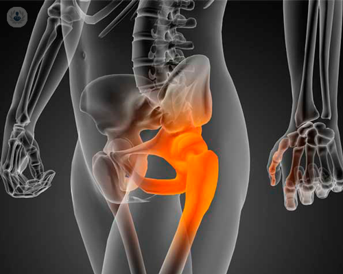 Artrosi dell’anca: diagnosi e terapia