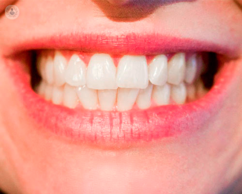 un-sorriso-piu-bello-senza-tartaro immagine dell'articolo