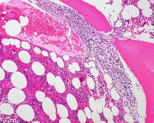 linfoma-sintomi-e-trattamento immagine dell'articolo