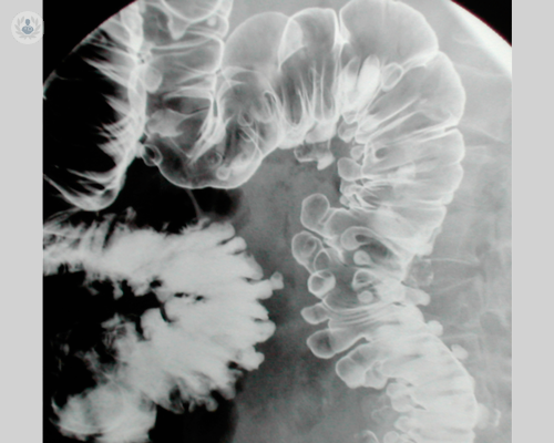 diverticolite-la-malattia-del-benessere immagine dell'articolo