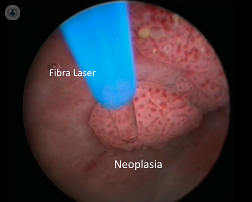 tumore-della-vescica-ecco-la-tecnica-laser immagine dell'articolo