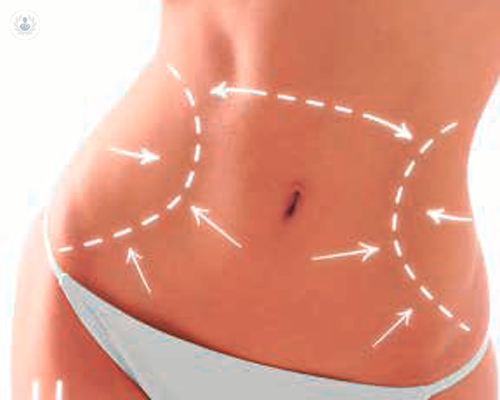 liposcultura-cosa-ci-si-deve-aspettare-dall-intervento immagine dell'articolo