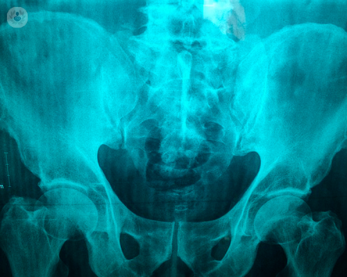 Protesi d’anca: cosa fare se il paziente è giovane?