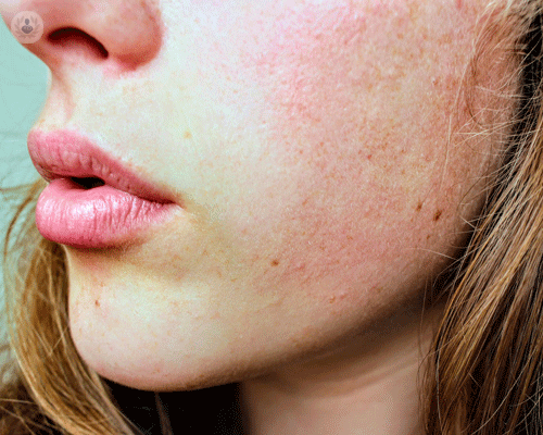 rosacea-cos-e-e-come-trattarla immagine dell'articolo