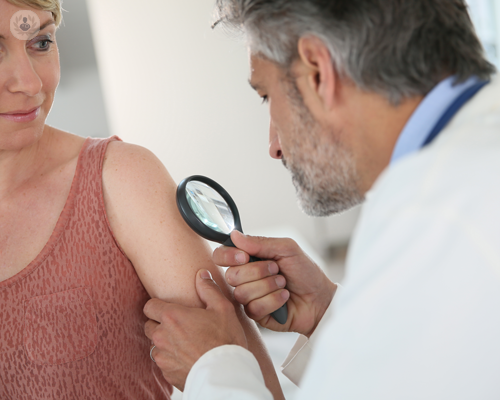 nevi-e-melanoma immagine dell'articolo