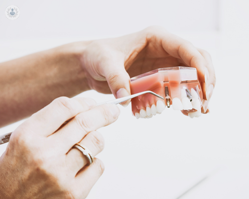 A cosa servono gli impianti dentali a carico immediato?