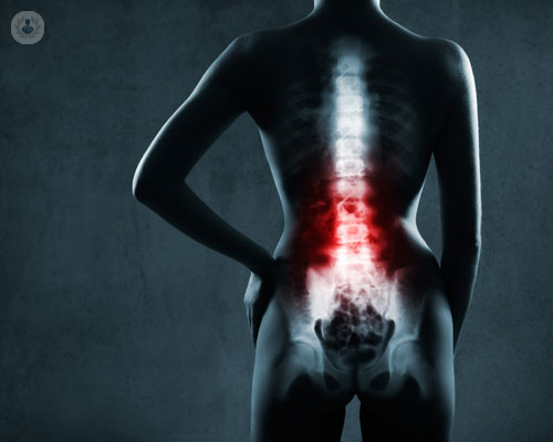 spondilolistesi-e-possibile-prevenirla immagine dell'articolo