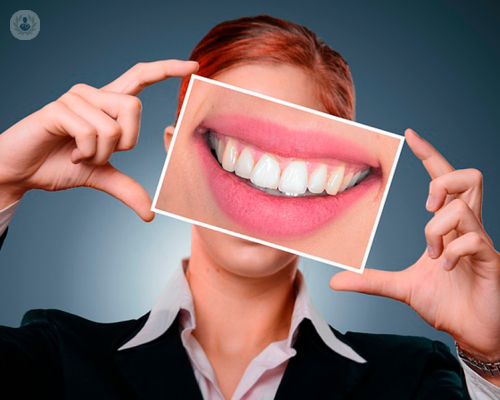 Differenze tra lo sbiancamento dentale professionale e quello casalingo-fai da te 