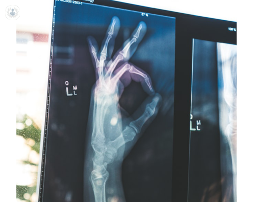 osteoporosi-e-fratture-da-fragilita-conosciamole-insieme immagine dell'articolo