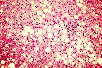 steatosi-epatica-e-ferritina-elevata-le-relazioni-pericolose immagine dell'articolo