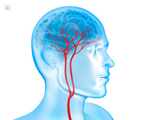 stenosi-carotidea-tutto-cio-che-c-e-da-sapere immagine dell'articolo