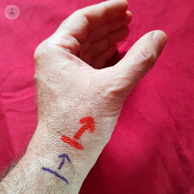 dito-a-scatto-e-polso-a-scatto-che-cosa-sono-e-come-si-curano immagine dell'articolo