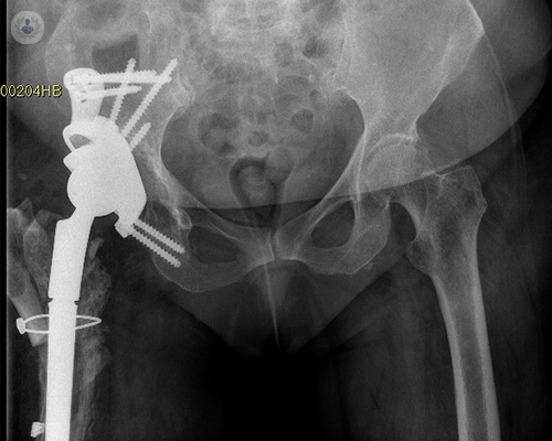 protesi-dell-anca-l-intervento-del-secolo immagine dell'articolo