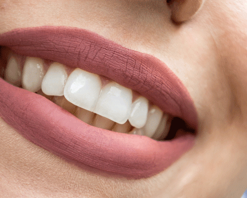 faccette-in-ceramica-per-la-risoluzione-di-problematiche-estetiche-come-si-applicano-e-perche-sceglierle immagine dell'articolo