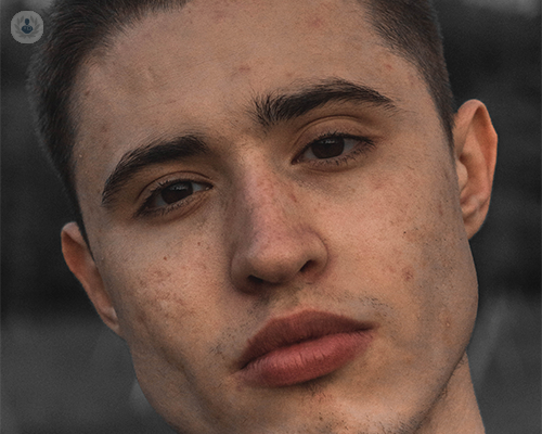parliamo-di-acne immagine dell'articolo