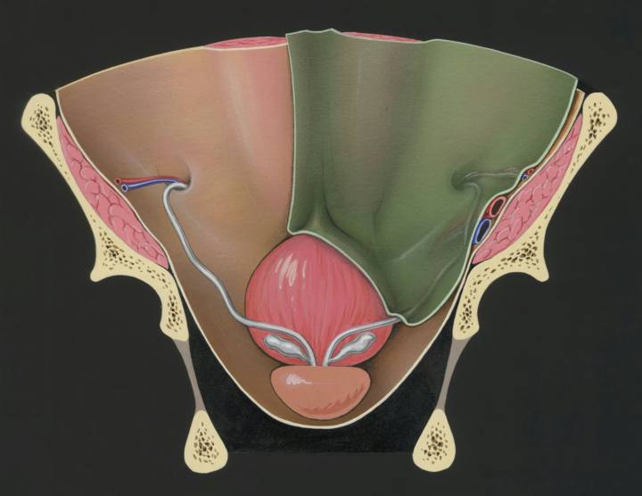 ipertrofia-prostatica-benigna-i-trattamenti immagine dell'articolo