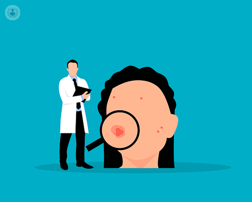 acne-un-problema-dalle-molteplici-sfaccettature immagine dell'articolo