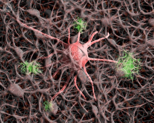 malattie-neurologiche-rare-come-riconoscerle immagine dell'articolo