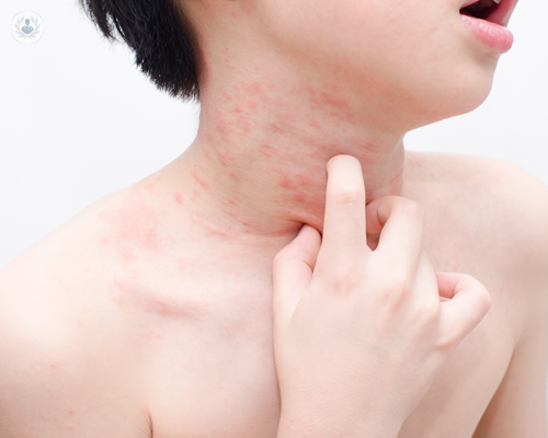 orticaria-cosa-fare immagine dell'articolo