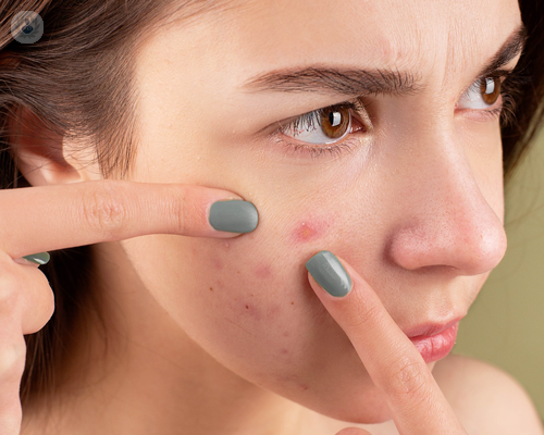 acne-che-inestetismo-fastidioso immagine dell'articolo