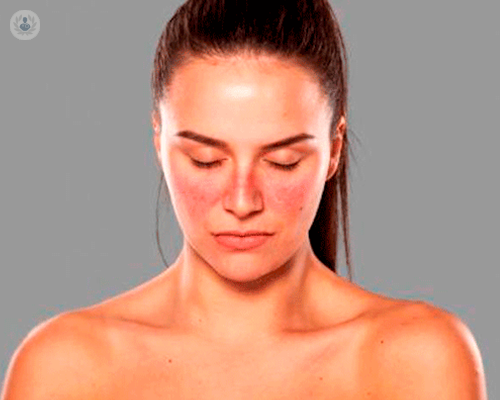 lupus-eritematoso-come-si-manifesta immagine dell'articolo
