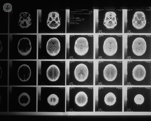 tumori-cerebrali-di-che-cosa-si-tratta immagine dell'articolo