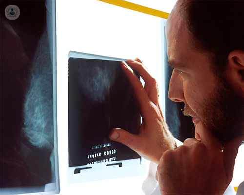 tumori-uroteliali-dell-apparato-urinario immagine dell'articolo