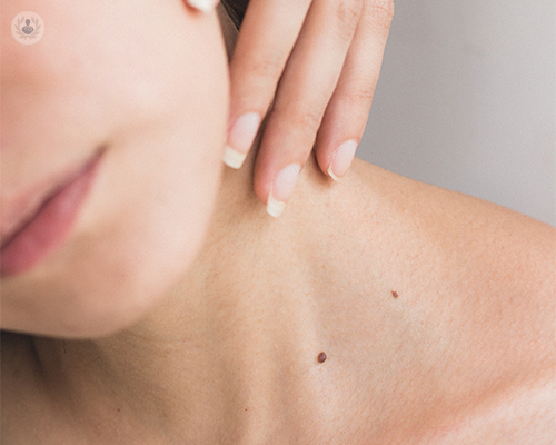 nei-e-melanoma-la-regola-dell-abcde immagine dell'articolo