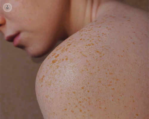 la-dermatoscopia-per-lo-studio-delle-lesioni-cutanee immagine dell'articolo