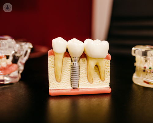 implantologia-a-carico-immediato-denti-fissi-in-meno-di-24-ore immagine dell'articolo
