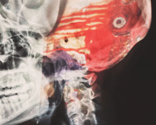 malformazione-di-chiari-di-cosa-si-tratta immagine dell'articolo