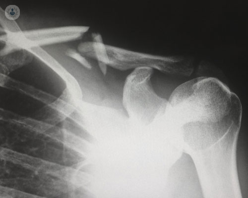 artroscopia-della-spalla-come-soluzione-ai-problemi-articolari immagine dell'articolo