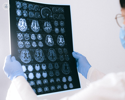 quando-il-cervello-sviluppa-i-vasi-sanguigni-in-modo-anomalo-le-malformazioni-arterovenose-cerebrali immagine dell'articolo