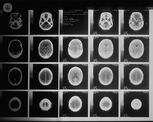 craniotomia-in-cosa-consiste immagine dell'articolo