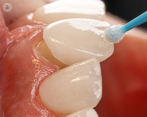 faccette-dentali-una-guida-utile-per-tutti immagine dell'articolo