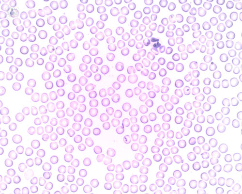 leucemia-linfatica-cronica-facciamo-il-punto immagine dell'articolo