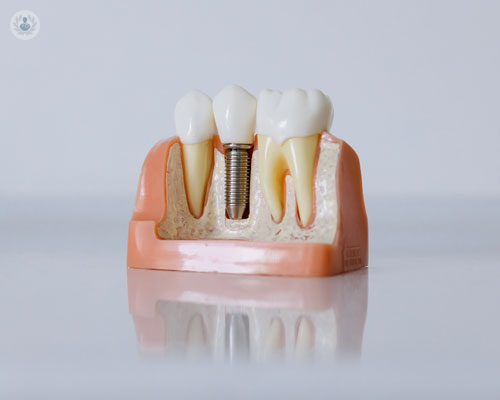 tutto-quello-che-devi-sapere-sull-implantologia-dentale immagine dell'articolo
